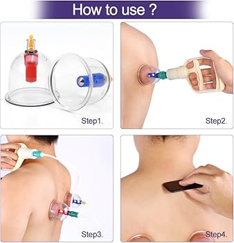 Ventouses (Vacuum Cupping)