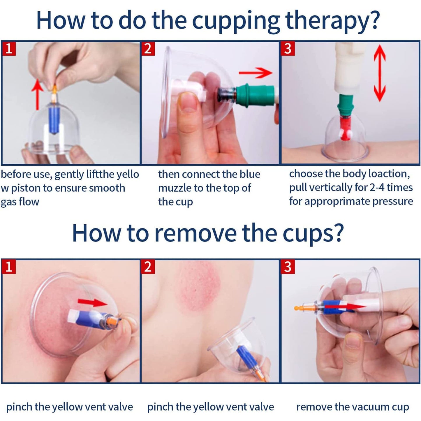 Ventouses (Vacuum Cupping)